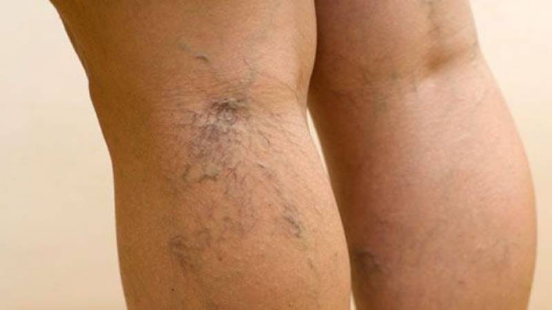 علل و درمان رگ‌های عنکبوتی و واریسی در بارداری | بهترین مطب زیبایی اصفهان