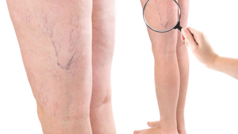 علل و درمان رگ‌های عنکبوتی و واریسی در بارداری | بهترین مطب زیبایی اصفهان