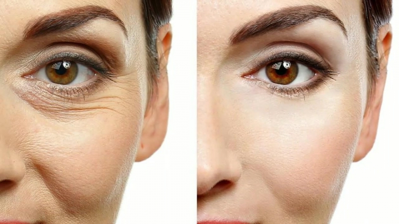 بوتاکس برای خطوط پنجه کلاغی دور چشم | بهترین مطب زیبایی اصفهان