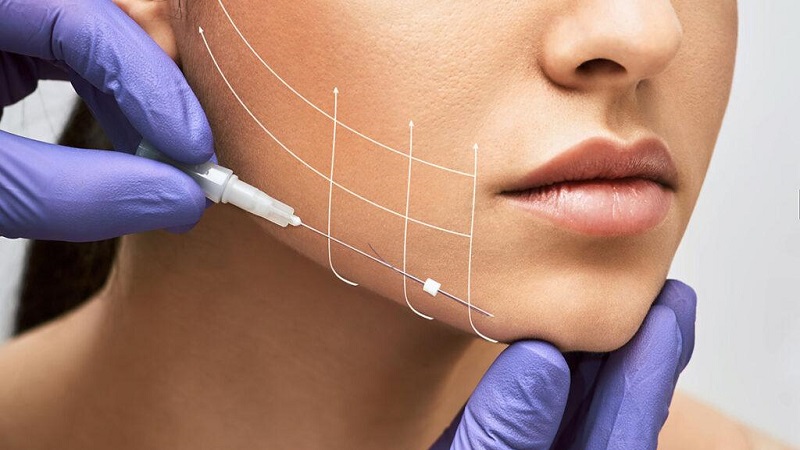 انواع لیفت با نخ | بهترین مطب زیبایی اصفهان