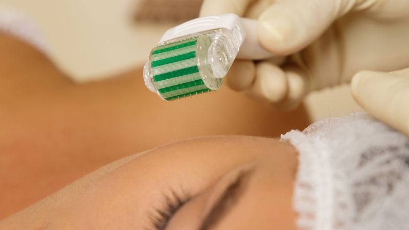 معرفی دستگاه های میکرونیدلینگ | بهترین مطب زیبایی اصفهان