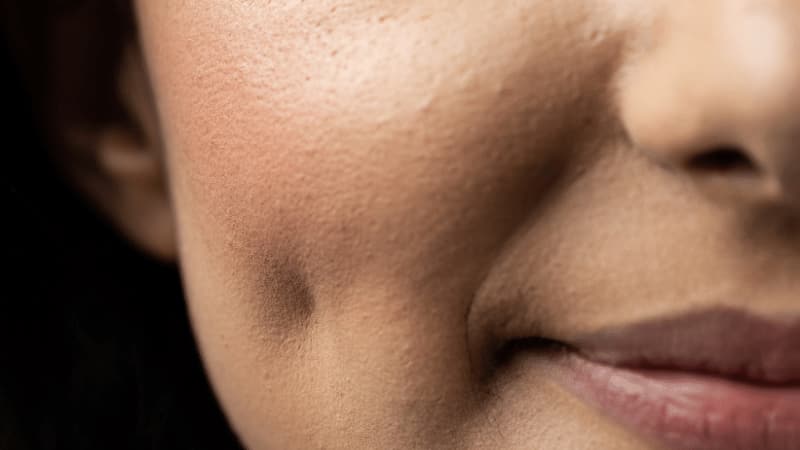 گود رفتگی گونه | تزریق ژل و بوتاکس اصفهان