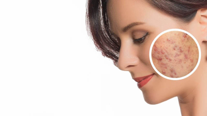 روشهای پیشگیری و درمان آکنه در بزرگسالان | بهترین مطب زیبایی اصفهان