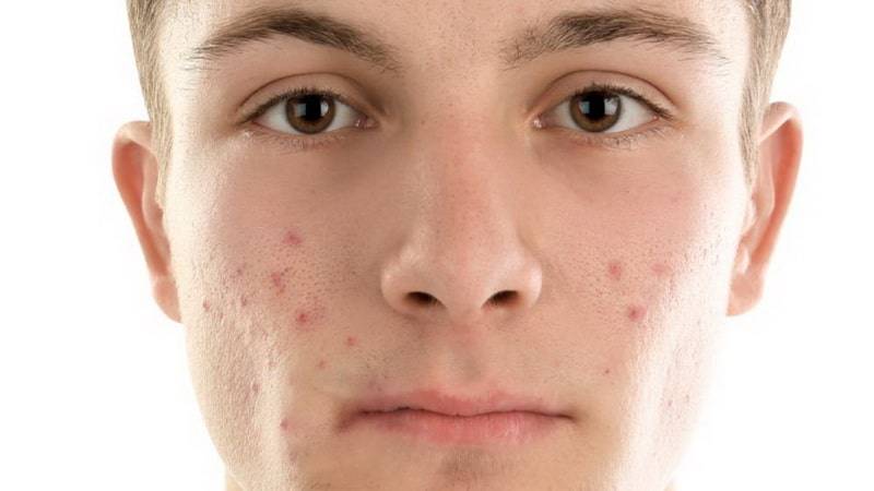 علل ایجاد انواع آکنه در بزرگسالان | تزریق ژل و بوتاکس اصفهان