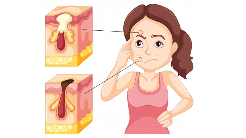 علل و علائم بیماری پوستی کورک | بهترین مطب زیبایی اصفهان