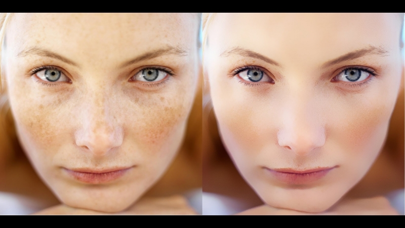 معرفی روش های درمان کک و مک | بهترین مطب زیبایی اصفهان