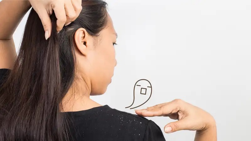 نکات درمانی شپش و شوره سر | بهترین مطب زیبایی اصفهان