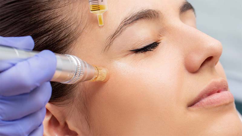 کاربرد انواع مزوتراپی صورت و مو | تزریق ژل و بوتاکس اصفهان