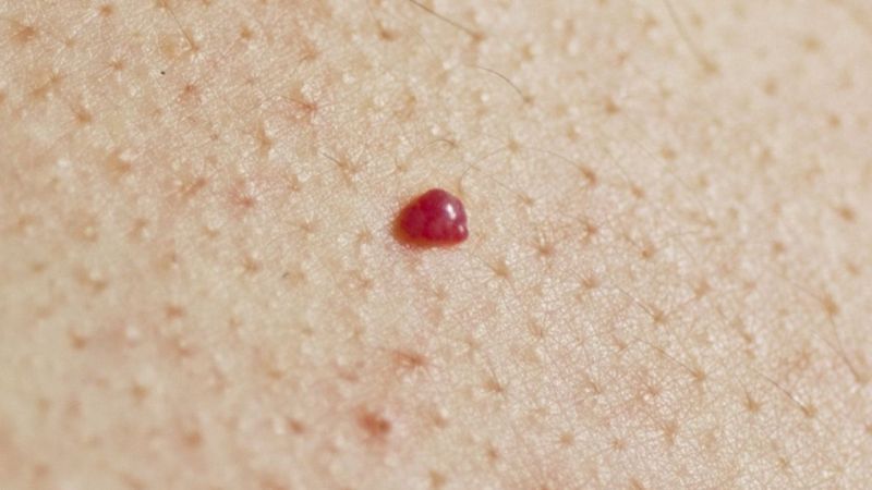 علل و علائم ایجاد خال های قرمز | بهترین مطب زیبایی اصفهان