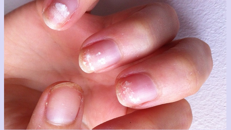 عوامل و علائم ایجاد قارچ در ناخن کاشت شده | بهترین مطب زیبایی اصفهان