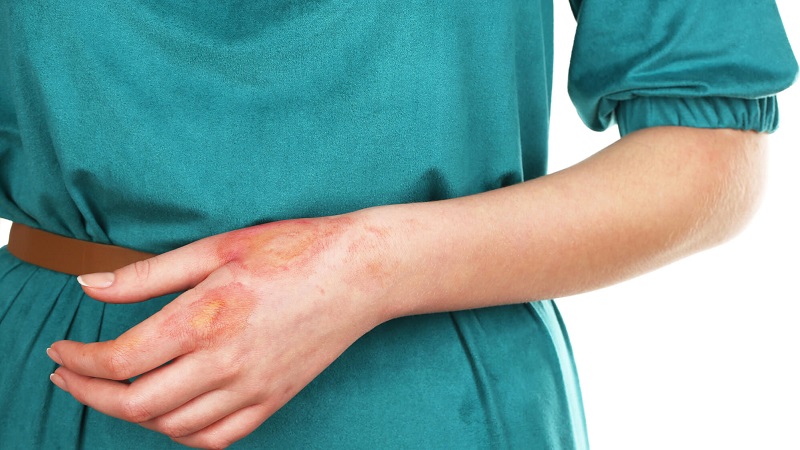 درمان عفونت زخم ناشی از سوختگی | بهترین مطب زیبایی اصفهان