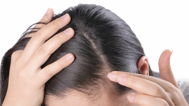 درمان علل خشکی پوست سر | تزریق ژل و بوتاکس اصفهان