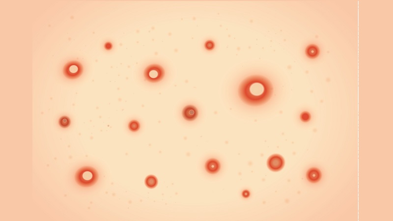 پیشگیری و درمان خال‌های قرمز | بهترین مطب زیبایی اصفهان