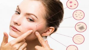 آنچه راجع به جوش صورت باید بدانید؟| دکتر مهناز کبیریان