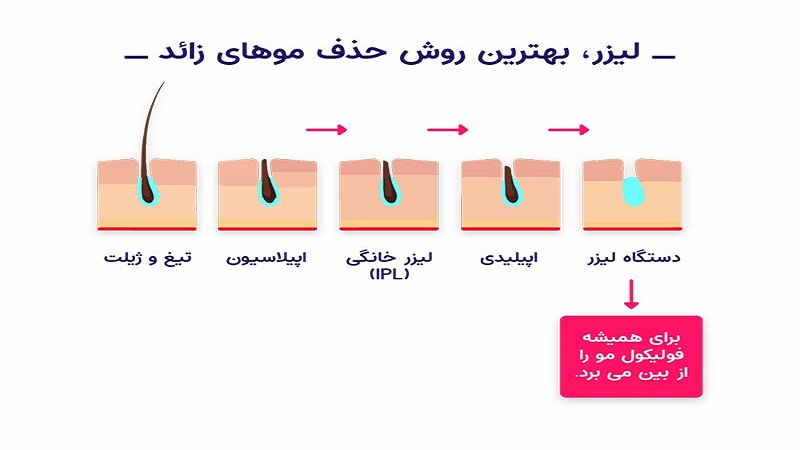 فواید لیزر موهای زائد بدن| دکتر مهناز کبیریان