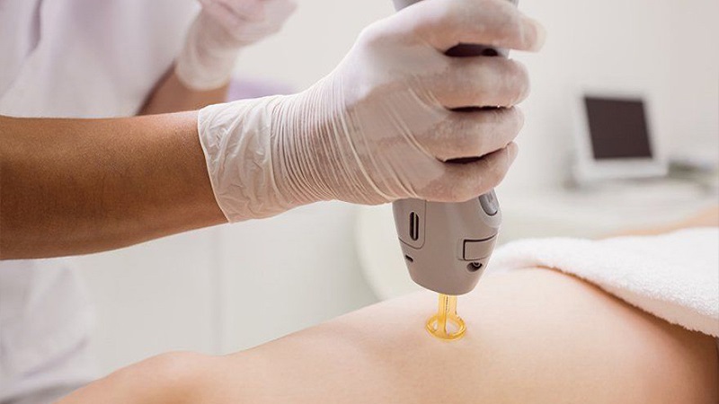 شات لیزر چیست؟ | بهترین مطب زیبایی اصفهان - تزریق ژل و بوتاکس اصفهان