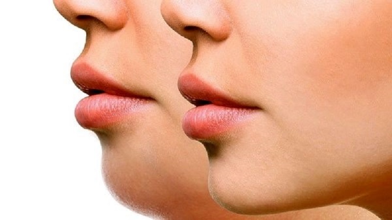 اندولیفت غبغب برای چه کسانی مناسب است؟ | بهترین مطب زیبایی اصفهان - تزریق ژل و بوتاکس اصفهان