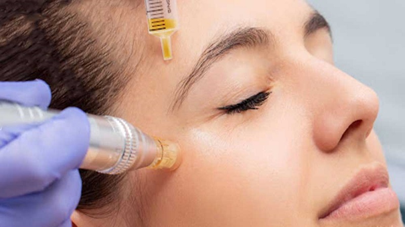 موارد منع انجام مزونیدلینگ زیر چشم | بهترین مطب زیبایی اصفهان - تزریق ژل و بوتاکس اصفهان