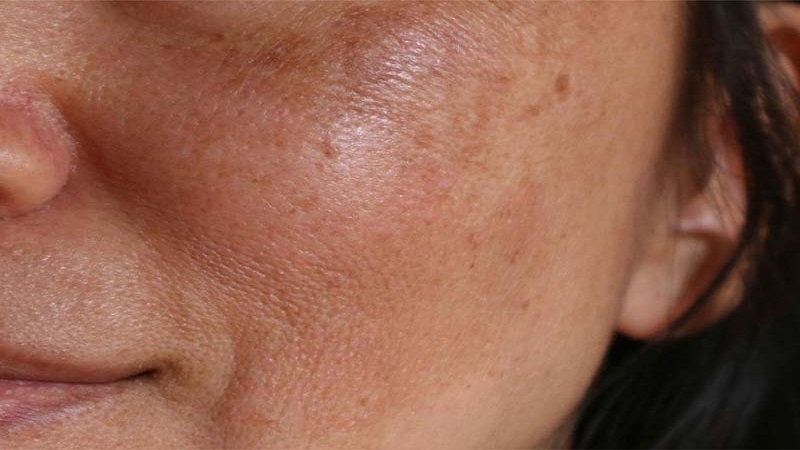 چگونه لکه‌ های پوستی بعد از زایمان را درمان کنیم؟ | بهترین مطب زیبایی اصفهان - تزریق ژل و بوتاکس اصفهان