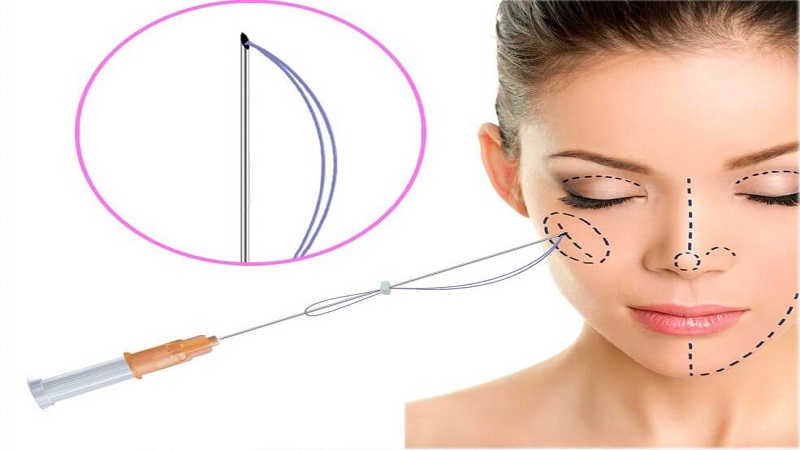 لیفت با نخ | بهترین مطب زیبایی اصفهان - تزریق ژل و بوتاکس اصفهان