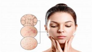 علت بزرگ شدن منافذ پوست چیست؟ | بهترین مطب زیبایی اصفهان - تزریق ژل و بوتاکس اصفهان