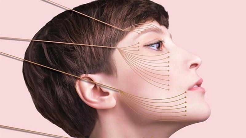 لیفت با نخ و روند انجام آن | بهترین مطب زیبایی اصفهان - تزریق ژل و بوتاکس اصفهان