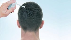 ماینوکسیدیل چیست؟ | بهترین مطب زیبایی اصفهان - تزریق ژل و بوتاکس اصفهان