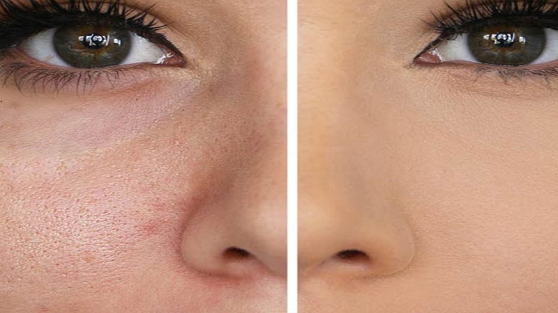 روش درمان منافذ باز پوست با میکرونیدلینگ | بهترین مطب زیبایی اصفهان - تزریق ژل و بوتاکس اصفهان