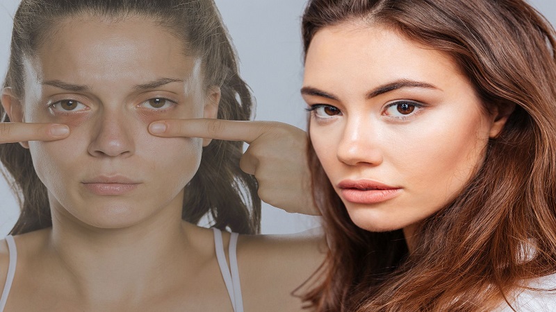 درمان گودی زیر چشم | بهترین مطب زیبایی اصفهان - تزریق ژل و بوتاکس اصفهان