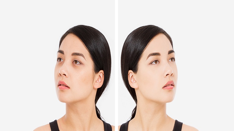 درمان گودی زیر چشم | بهترین مطب زیبایی اصفهان - تزریق ژل و بوتاکس اصفهان