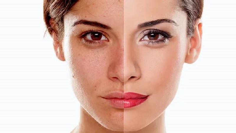 کربوکسی تراپی برای لک صورت | بهترین مطب زیبایی اصفهان - تزریق ژل و بوتاکس اصفهان