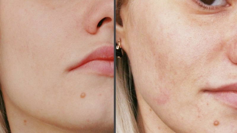 کربوکسی تراپی برای لک صورت | بهترین مطب زیبایی اصفهان - تزریق ژل و بوتاکس اصفهان