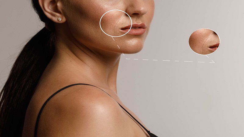 از بین بردن خط خنده | بهترین مطب زیبایی اصفهان - تزریق ژل و بوتاکس اصفهان