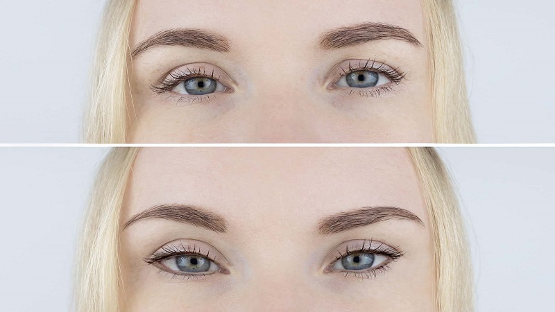 چشم گربه ای | بهترین مطب زیبایی اصفهان - تزریق ژل و بوتاکس اصفهان