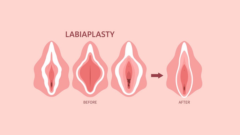 موارد استفاده از لیزر در جوانسازی ناحیه تناسلی بانوان | بهترین لابیاپلاستی اصفهان | دکتر مهناز کبیریان