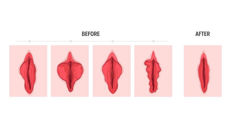 آیا تنگ کردن واژن با لیزر روش دائمی است؟ | بهترین لابیاپلاستی اصفهان | دکتر مهناز کبیریان