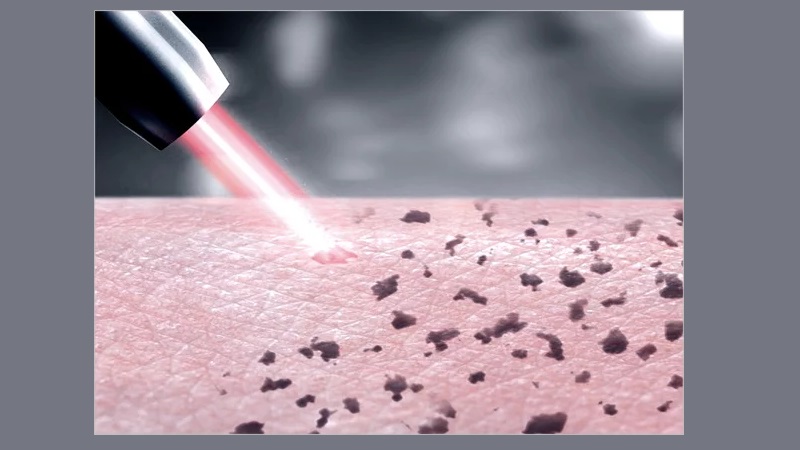 مقایسه سفید کردن واژن با لیزر و کرم | بهترین لابیاپلاستی اصفهان | دکتر مهناز کبیریان