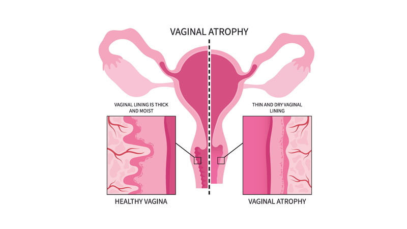 موارد استفاده از لیزر در جوانسازی ناحیه تناسلی بانوان | بهترین لابیاپلاستی اصفهان | دکتر مهناز کبیریان