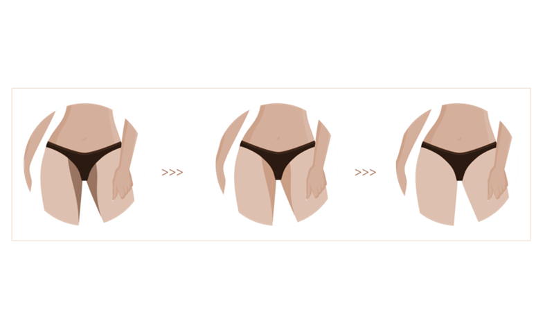 ماندگاری روش‌های روشن کردن ناحیه ژنیتال | فیلر ژنیتال اصفهان | دکتر مهناز کبیریان