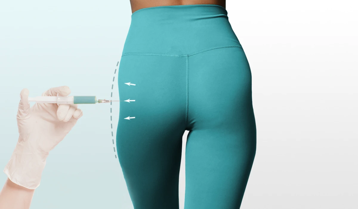 فیلر هیپ‌دیپ؛ رفع گودی کنار باسن