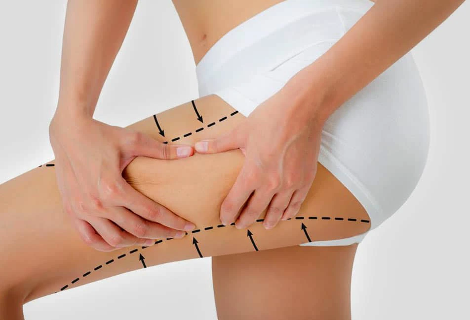 لاغری ران بدون ورزش با اگزیمیا؛ واقعیت یا تبلیغ؟